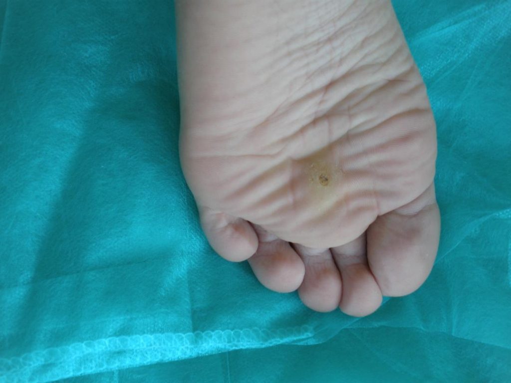 Verucă Plantară